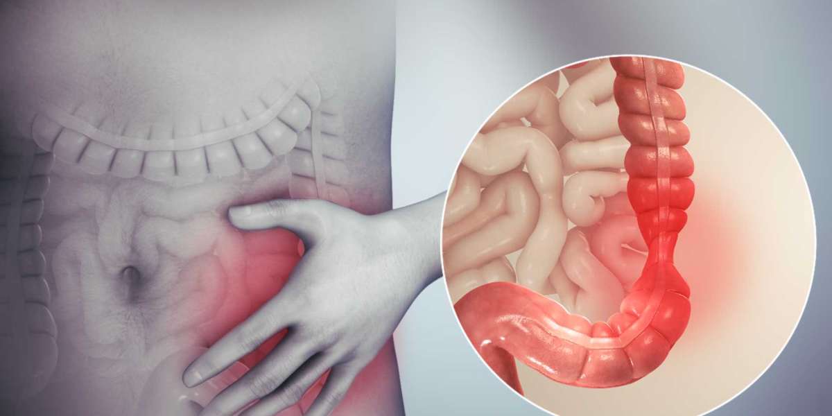 Irritable Bowel Syndrome Treatment Market: A Growing Opportunity for Innovation
